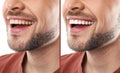 Smiling man before and after teeth whitening procedure Royalty Free Stock Photo