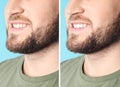 Smiling man before and after teeth whitening procedure Royalty Free Stock Photo