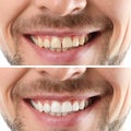 Smiling man before and after teeth whitening procedure Royalty Free Stock Photo