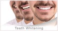 Smiling man before and after teeth whitening procedure Royalty Free Stock Photo