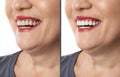 Smiling mature woman before and after teeth whitening procedure Royalty Free Stock Photo