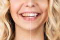 Smiling woman before and after the teeth whitening procedure, close-up image. Royalty Free Stock Photo