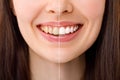 Smiling woman before and after the teeth whitening procedure, close-up image. Royalty Free Stock Photo