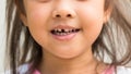 Smilling girl with broke upper milk tooth by accident Royalty Free Stock Photo