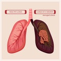 Smoker lungs. Smoke human damage lung cancer vector medical infographic pictures