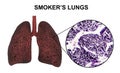 Smoker`s lungs, medical concept