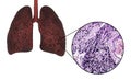 Smoker`s lungs, medical concept