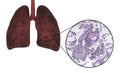 Smoker`s lungs, medical concept