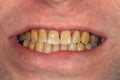 Smoking, plaque on teeth Brown resinous plaque on teeth close-up. Smoking harm concept