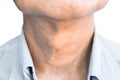 Smooth, diffuse thyroid swelling of Southeast Asian, Myanmar or Burmese young man. A goiter can occur with hypothyroidism or