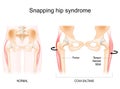 Snapping hip syndrome. Coxa saltans Royalty Free Stock Photo