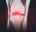 A snapshot of the diagnosis of an MRI of the knee in which arthrosis and arthritis. The concept of joint diagnosis using x-rays, Royalty Free Stock Photo