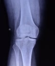 A snapshot of the knee joint with a diagnosis of gonarthrosis. Arthrosis of the knee joint snapshot. Royalty Free Stock Photo