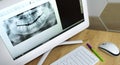 Snapshot of a tooth on a computer monitor. x-ray of teeth Royalty Free Stock Photo