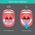 Snore Laser Treatment.