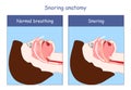 Snoring anatomy. Normal breathing and Snoring