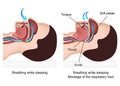 Snoring medical illustration with description on white background