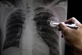 Soft and blurry image chest x-ray film of a patient with cardiac pacemaker, also with congestive heart and cardiomegaly.By surgery Royalty Free Stock Photo