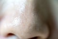 Soft focus acne blackheads on skin of nose and spot melasma pigmentation on facial Asian woman