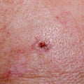 Solar keratosis or basalioma on human scalp