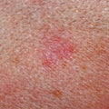 Solar keratosis or basalioma on human scalp Royalty Free Stock Photo