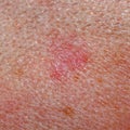 Solar keratosis or basalioma on human scalp