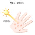 Solar keratosis. Dry scaly patches of skin