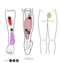 Soleus: Treating myofascial trigger points in the Soleus calf muscle