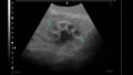 Sonogram of human kidney. Ultrasound diagnostic