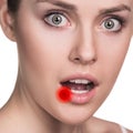 Sore on the female lips Royalty Free Stock Photo