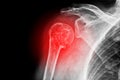 Sore human shoulder Royalty Free Stock Photo