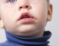 sore on the lip of the child herpes Royalty Free Stock Photo