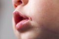 Sore on the lip of the child herpes Royalty Free Stock Photo