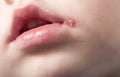 Sore on the lip of the child herpes