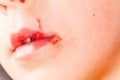 sore on the lip of the child herpes Royalty Free Stock Photo