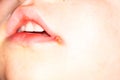 Sore on the lip of the child herpes Royalty Free Stock Photo