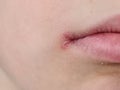 Sore on lip of child and peeling of skin Royalty Free Stock Photo