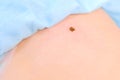Sore of removed mole after laser removal on patient back, closeup view.