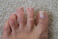 Sore skin on feet dry dehydrated feet of a lady ,five toes with clean skin