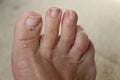 Sore skin on feet dry dehydrated feet of a lady ,five toes with clean skin