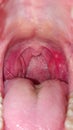 Sore throat inside the mouth, closeup. Diseases of the throat and mucous membrane, redness of the throat and tonsils