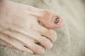 Sore toe Royalty Free Stock Photo