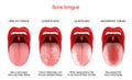 Sore or white tongue. comparison of healthy tongue and oral disease