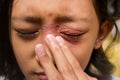 Southeast Asian ethnicity teenage girl annoyed with itchy skin disease, dermatitis problem on her face, scratching over it Royalty Free Stock Photo