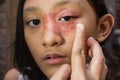 Southeast Asian ethnicity teenage girl with circular shape dry skin rash on her face around the eye and nose, being applied