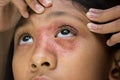 Southeast Asian ethnicity teenage girl with circular shape dry skin rash on her face around the eye and nose, Tinea corporis Royalty Free Stock Photo