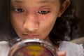 Southeast Asian ethnicity teenage girl with circular shape skin rash on her face around the eye and nose, Sadly looking at mirror Royalty Free Stock Photo