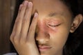 Southeast Asian ethnicity teenage girl with circular shape dry skin rash on her face around the eye and nose, Dermatitis skin