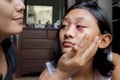 Southeast Asian ethnicity teenage girl with circular shape skin rash on her face, being applied cream by her mother