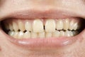 Spacing Teeth Royalty Free Stock Photo